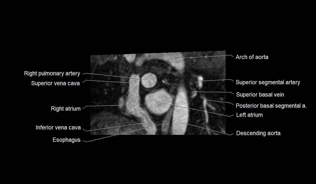 MRI heart and coronary arteries short axis anatomy image 7.webp